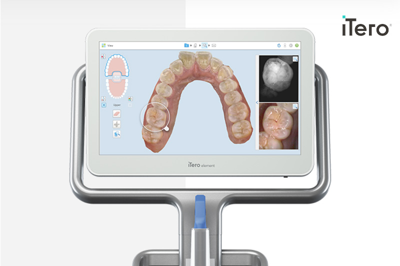 iTero Intra-Oral Cameras in 