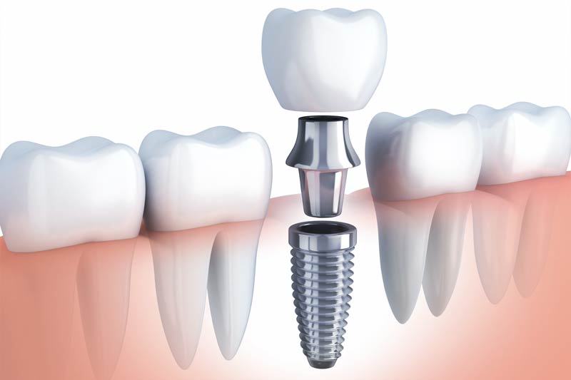 Dental Implants in Sacramento