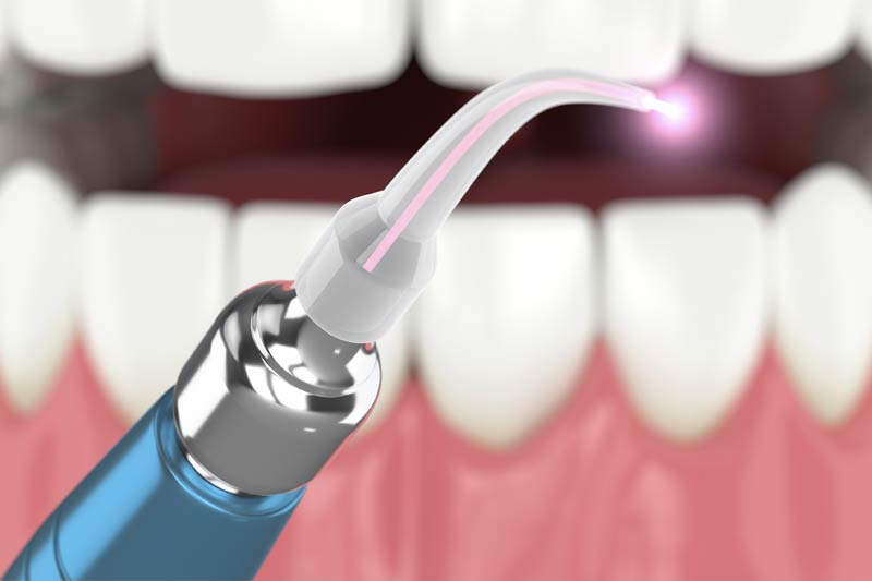 Laser Dentistry in Sacramento